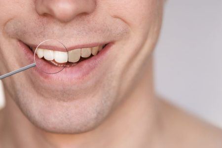 Λεύκανση δοντιών